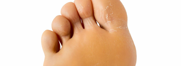 Rimuovere la pelle ispessita del piede