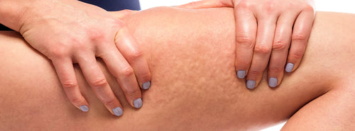 Calze a compressione graduata e cellulite: un rimedio o no?