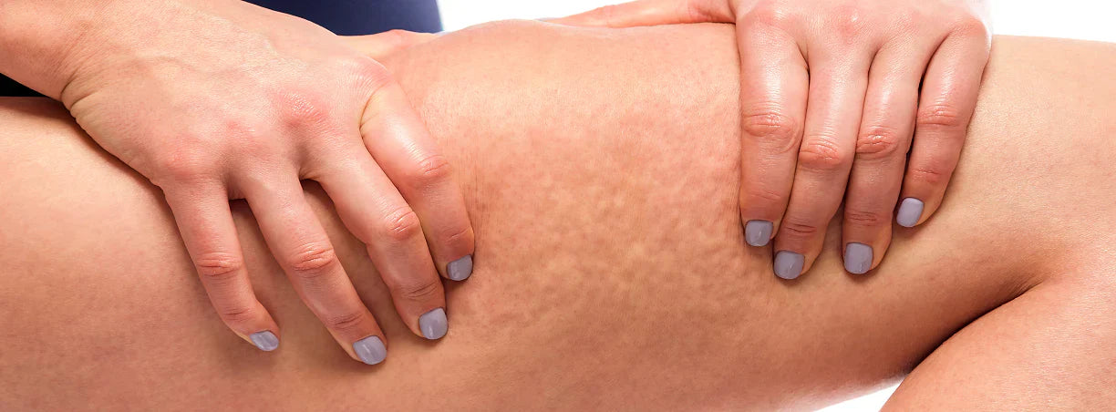 Calze a compressione graduata e cellulite: un rimedio o no?