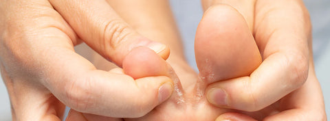 Funghi dei piedi: quali sono, come riconoscerli e trattarli