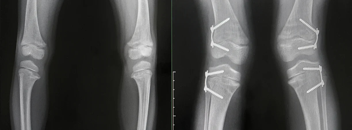 Ginocchio Varo e Valgo: cause e rimedi