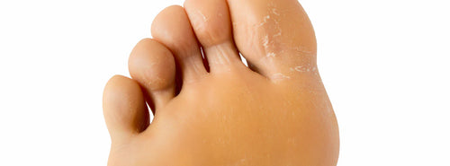 Rimuovere la pelle ispessita del piede