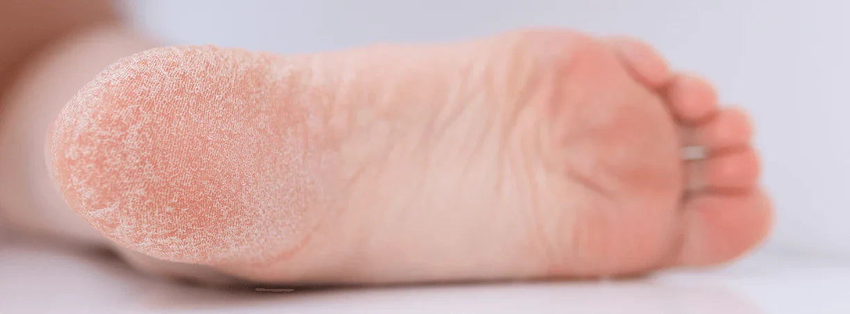 Piedi secchi, screpolati, che si spellano: cosa fare?