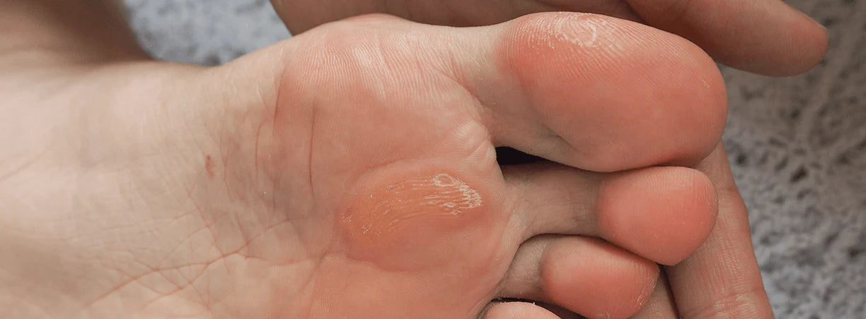 Tipi di calli: quali sono e come riconoscerli